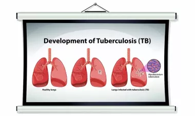 223 patients currently suffer from tuberculosis in Jordan