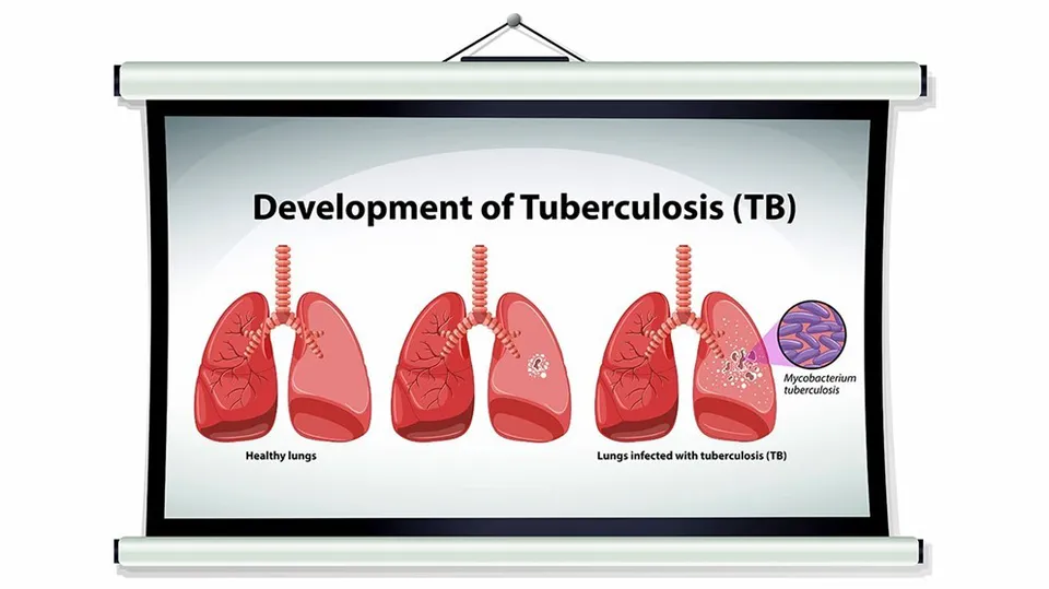 223 patients currently suffer from tuberculosis in Jordan