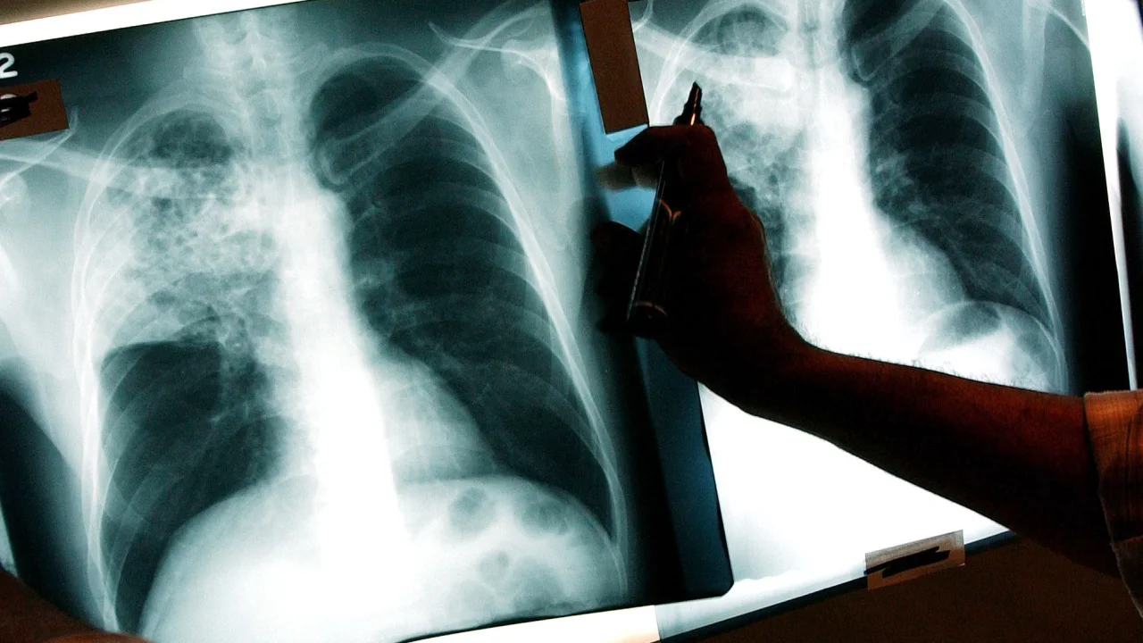 US tuberculosis cases nearing pre-pandemic levels, CDC data shows