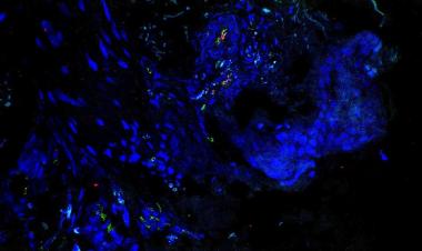 NIH researchers discover new autoinflammatory disease, suggest target for potential treatments