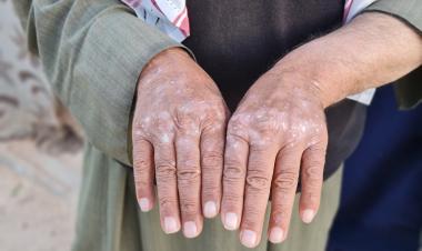 الفطريات الجلدية تصيب آلاف المدنيين شمالي سوريا