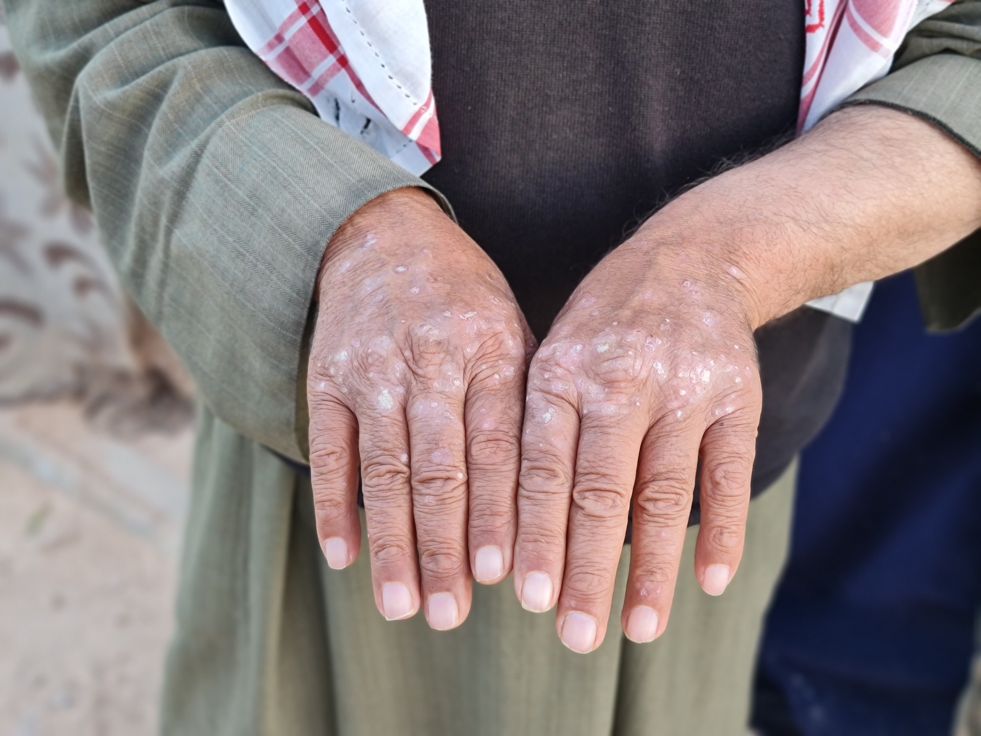 الفطريات الجلدية تصيب آلاف المدنيين شمالي سوريا