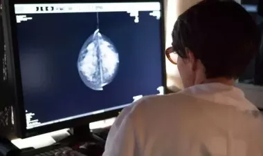 Aberdeen AI trial helps doctors spot breast cancers