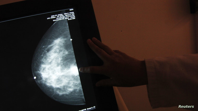 دراسة تحذر من إهمال الفحص المبكر لسرطان الثدي لدى النساء