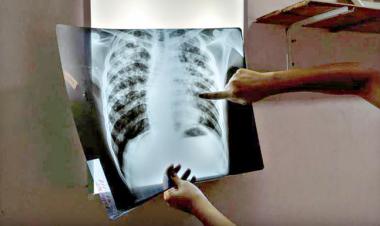 31% of TB patients remain undiagnosed: Health experts