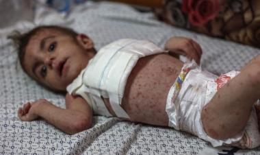 Dangerous skin diseases spreading among Gaza children