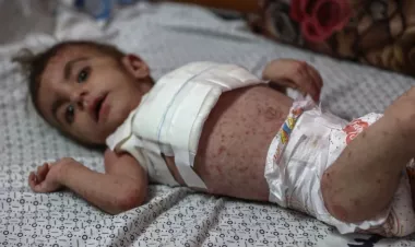 Dangerous skin diseases spreading among children in Gaza