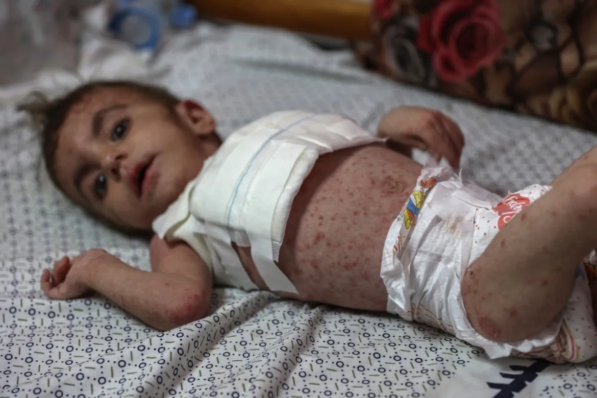 Dangerous skin diseases spreading among children in Gaza