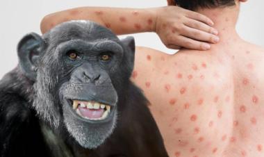 Health Ministry addresses Monkeypox concerns amid rising number of global cases