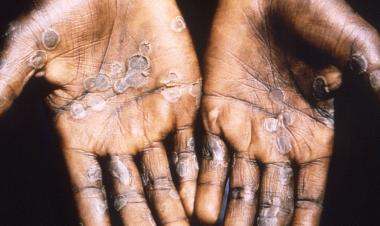 Mpox: What you need to know about the latest public health emergency