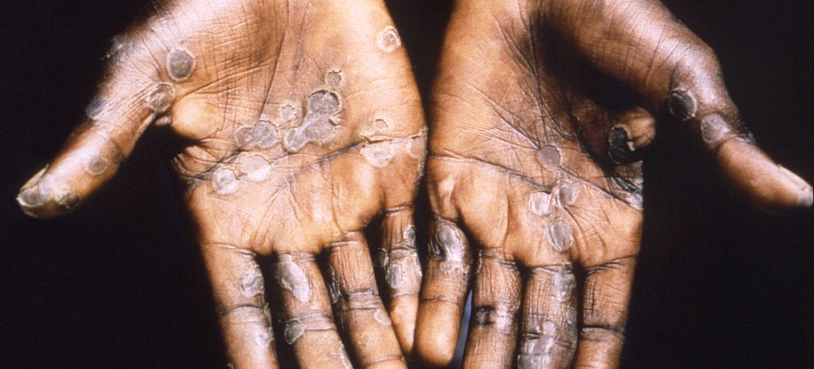 Mpox: What you need to know about the latest public health emergency