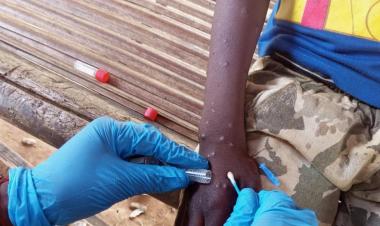 IOM Appeals for USD 18.5 Million to Urgently Aid Mpox-Affected Populations in East, Southern Africa