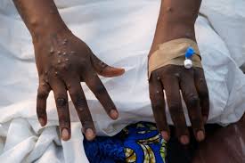 Almost 30,000 suspected mpox cases in Africa this year, WHO says