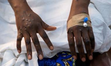 WHO approves Bavarian Nordic's mpox vaccine for adolescents