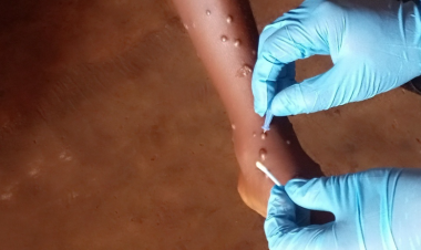 WHO approves first mpox diagnostic test for emergency use, boosting global access