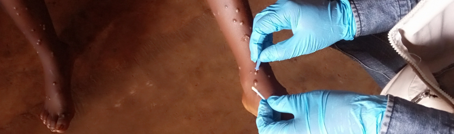 WHO approves first mpox diagnostic test for emergency use, boosting global access