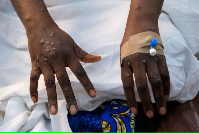 Mpox cases on African continent show 500% increase year-on-year