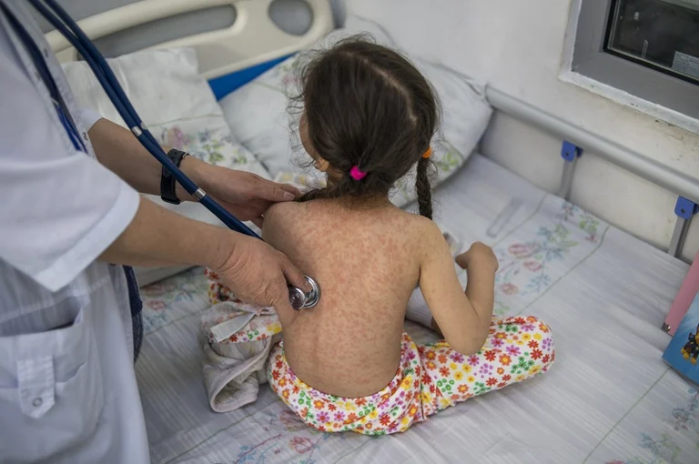 Measles cases surge worldwide, infecting 10.3 million people in 2023