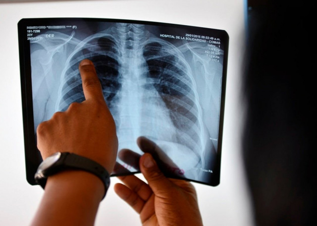 Pakistan faces alarming rise in TB cases, deaths