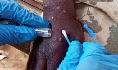 WHO Ends International Emergency Declaration for Mpox – But African Continental Alert Remains