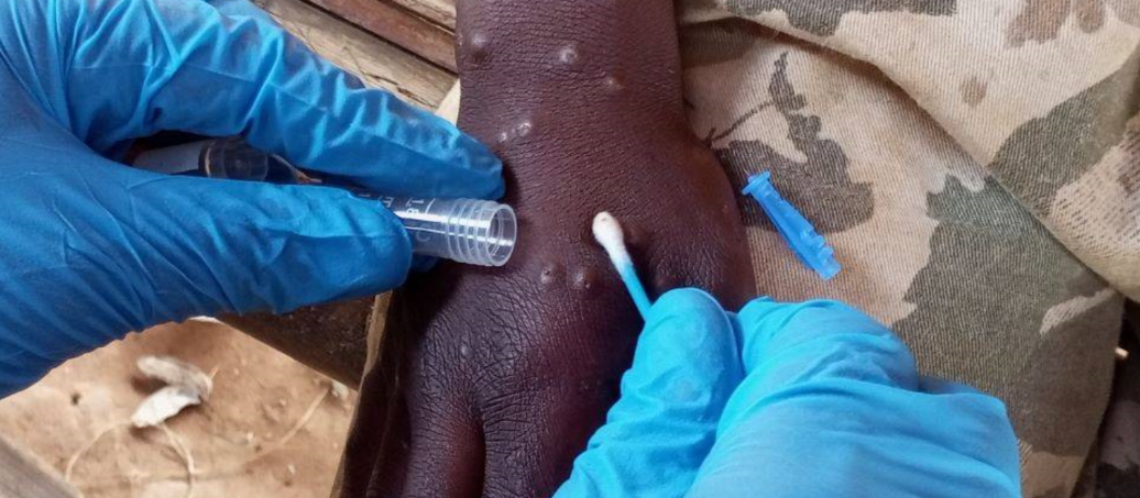 WHO Ends International Emergency Declaration for Mpox – But African Continental Alert Remains