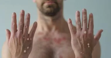 المركز الأفريقى لمكافحة الأمراض يرفع حالة الطوارئ المرتبطة بجدرى القرود