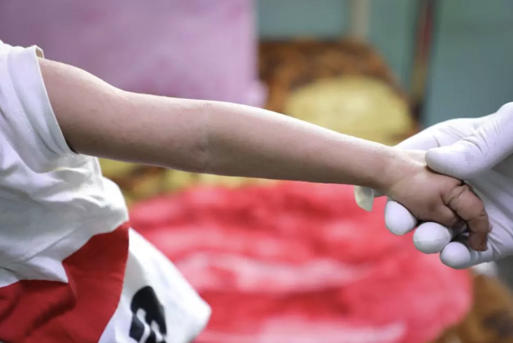 Yemen Health Office Reports Measles Outbreak With Over 1,200 Cases