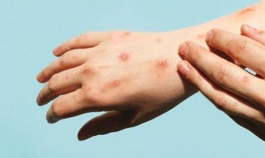 الصحّةُ العالميّةُ ترصد فيروسًا متحورًا يضم سلالتين من جدري القرود