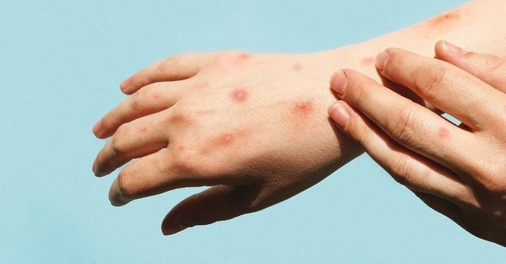 الصحّةُ العالميّةُ ترصد فيروسًا متحورًا يضم سلالتين من جدري القرود