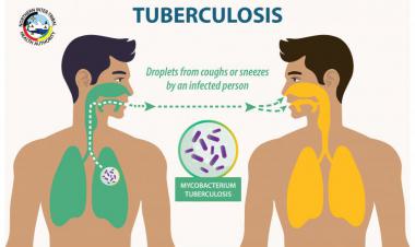 Tuberculous meningitis: What to know