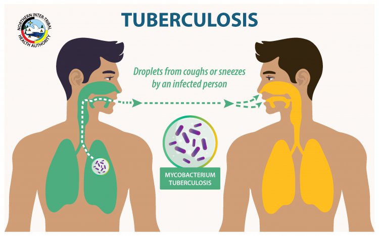 Tuberculous meningitis: What to know