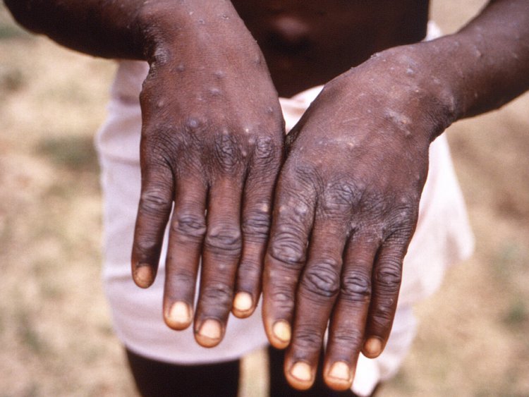 WHO to assess if monkeypox an international health emergency