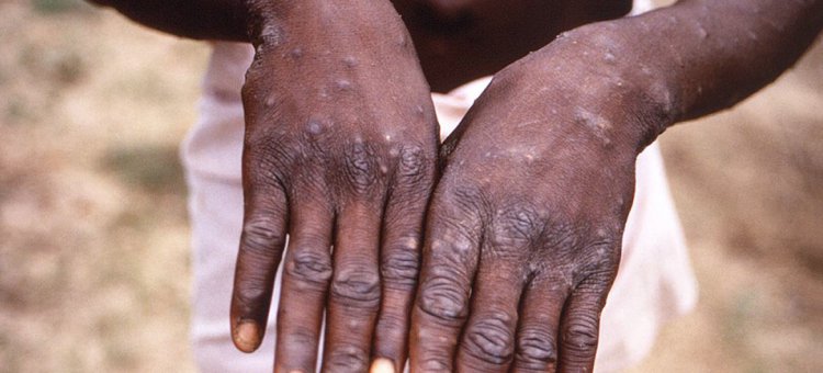 Animal-to-human diseases on the rise in Africa, warns UN health agency