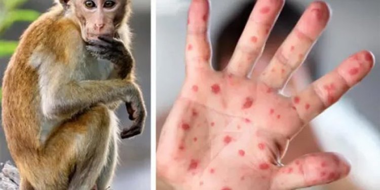 إندونيسيا تسجل أول إصابة بفيروس جدري القرود