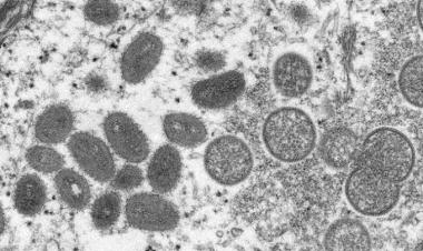 Bahrain reports first case of monkeypox virus