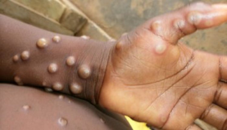 Seven cases of monkeypox reported in West Darfur