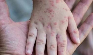 Egypt announces second monkeypox case