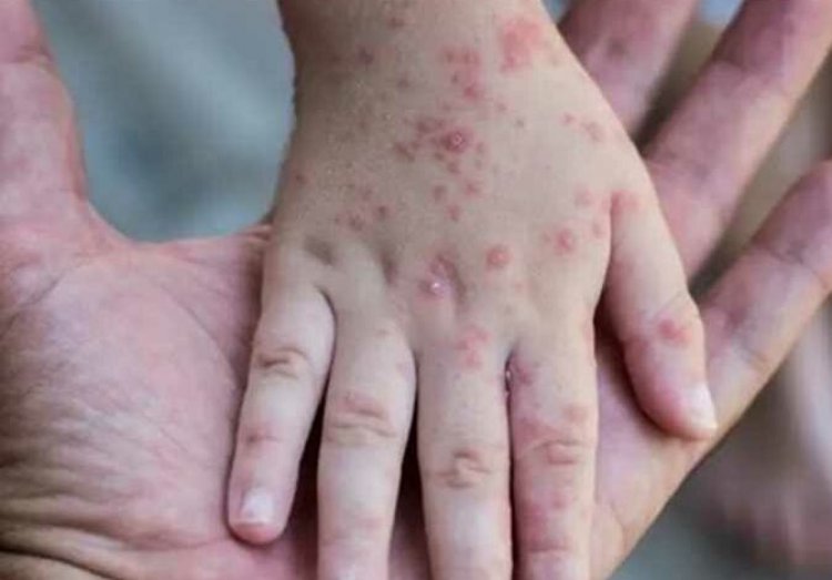 Egypt announces second monkeypox case