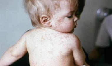 WHO declares Egypt clear of measles, rubella